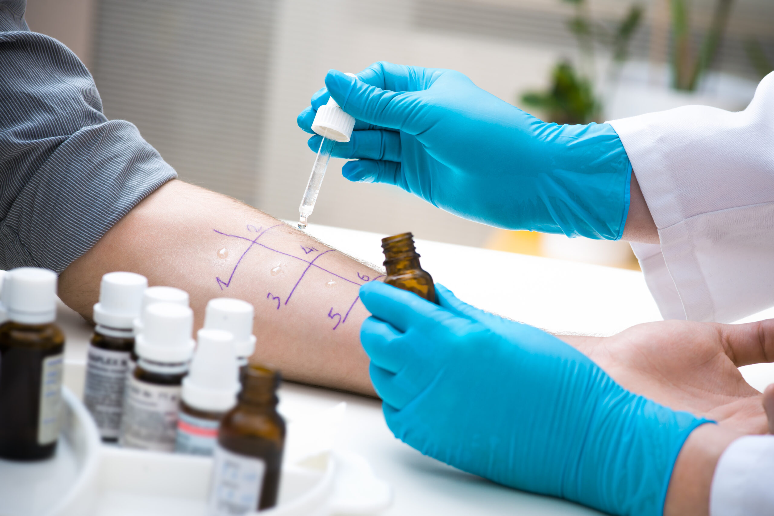 Was könnte das „ABC“ in der Allergie sein?
